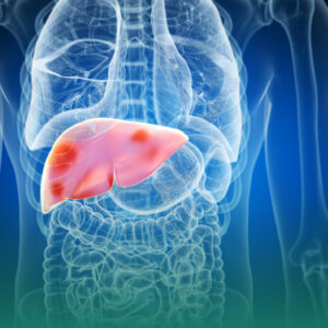 Tuberculosis