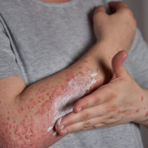 Herpes Zóster
